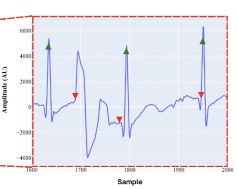 DPN HRV ECG signal